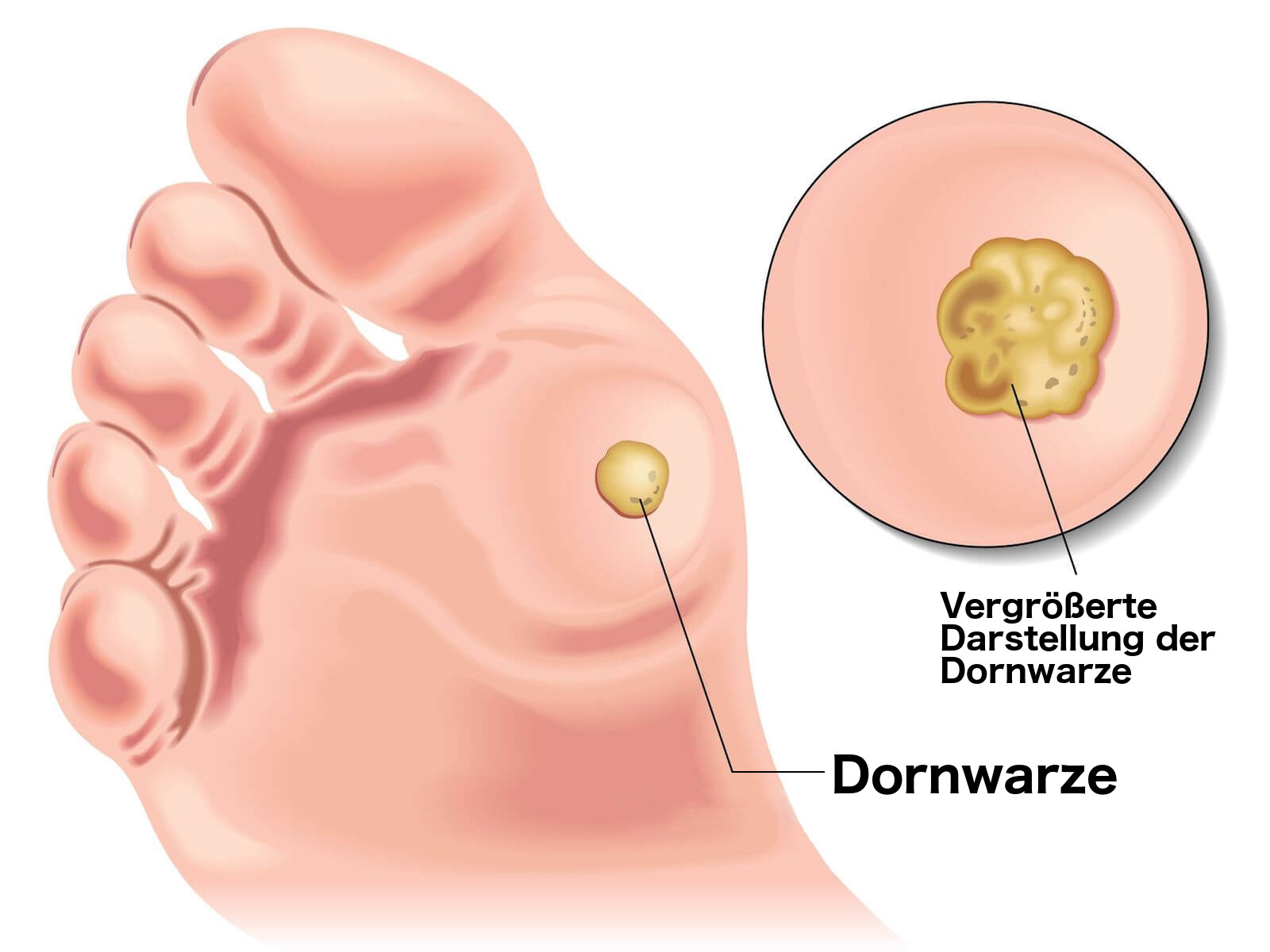 Hühnerauge oder warze